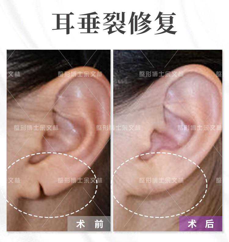 耳垂畸形修复手术后，会出现严重的并发症吗？