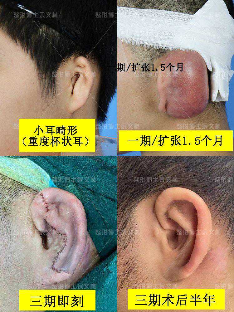 小耳畸形修复术要等几个月左右才好看，你知道为什么吗？